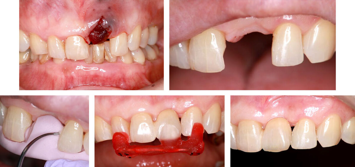 図７ 欠損部が大きな症例に対する片側リテーナーブリッジ 抜歯直後（上左）、形成後（上右）、コンポジットレジン添加（下左）、 装着位置を規定するインディケーター（下中央）、装着後（下右）