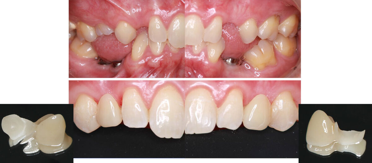 図8先天性欠損を含む歯列（上段）に装着した片側リテーナー接着ブリッジ（下段）