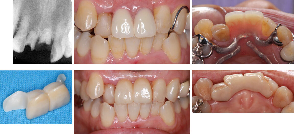 図９上顎左右中切歯欠損に装着した接着ブリッジ１ 転倒し破折した上顎中切歯（上左）抜歯後に装着した義歯（上中央、右）。異物感が強く、置き換えた接着ブリッジのプロビジョナル（下左）、装着後５年経過時の口腔内（下中央、右）。