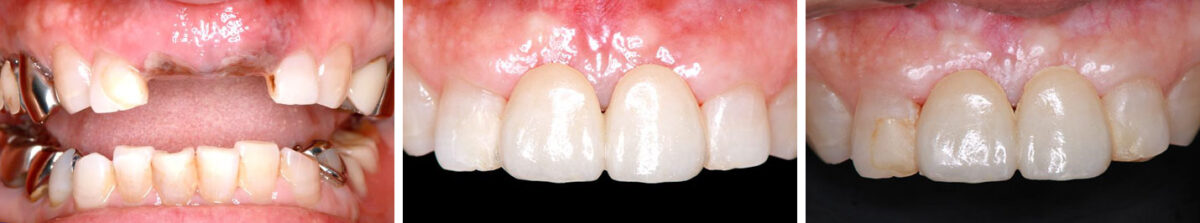 図10 上顎左右中切歯欠損に装着した接着ブリッジ２ 抜歯直後（左）、接着ブリッジ装着時（中央）、５年経過時（右）の口腔内。