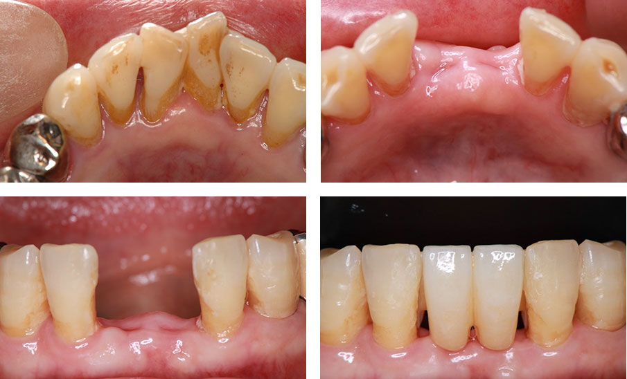 図11下顎左右中切歯欠損に装着した接着ブリッジ 抜歯前（上左）、抜歯後（上右）、接着ブリッジ装着前（下左）、接着ブリッジ装着時（下右）の写真。