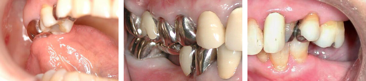 図12 舌癖で顎関節症状を発症した症例 クラウンの粗造が気になる（左）、ポンティックのスペースが気になる （中央）、無意識に欠損部へ舌が入る（右）