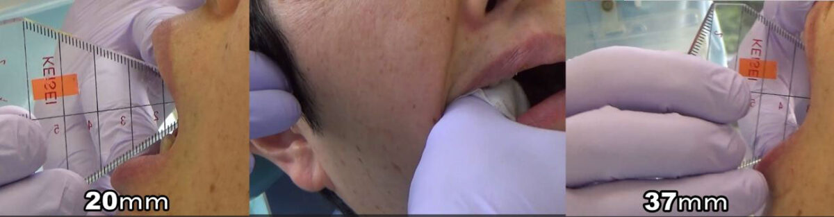 図13徒手的授動術 術前の開口量（左）、術中（中央）、術後の開口量（右）